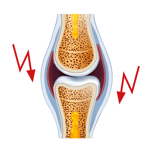 Entzündung des Gelenks durch Reize