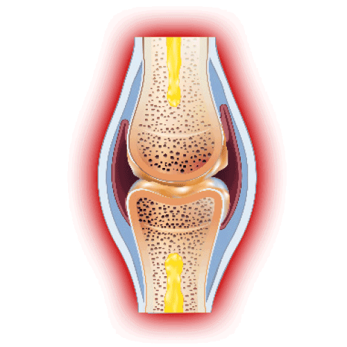 Entzündetes Gelenk mit Schäden von Gelenkschmerzen und Arthrose